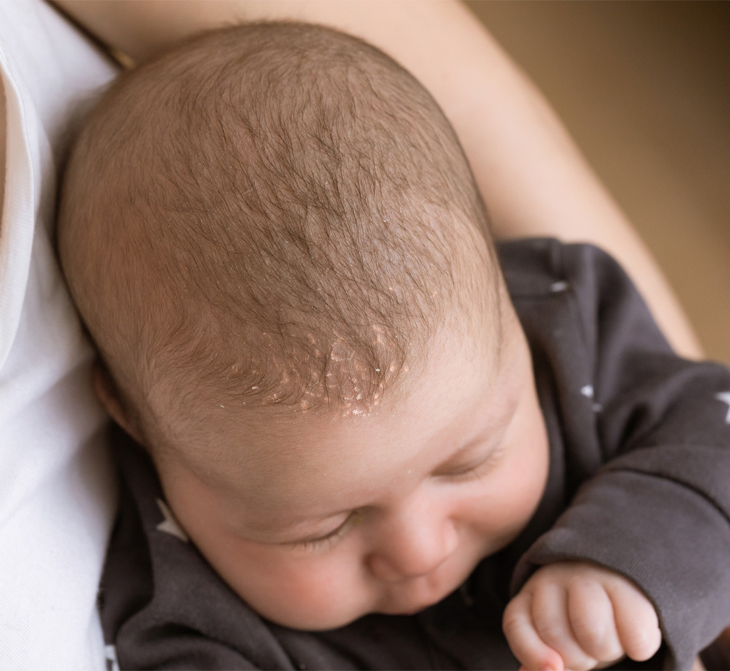 Молочные корочки на голове у новорожденного